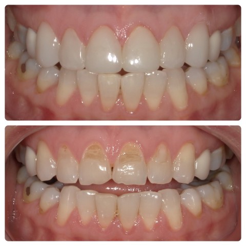 composite-veneers-issaquah