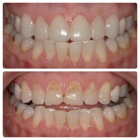 composite-veneers-issaquah